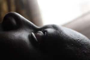 Acanthosis Nigricans 1 Acanthosis Nigricans