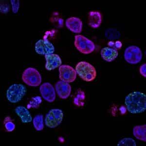 Colorectal Cancer 1 Colorectal Cancer