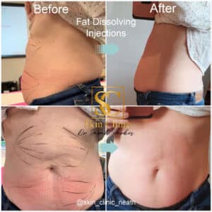 fat burning injections near me 2